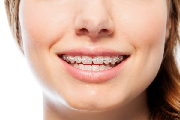 Why You Should Consider Clear Braces - Carolina Smiles Family Dental  Brevard North Carolina