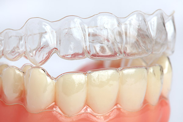 Invisible Braces for Straight Teeth and a Healthy Smile