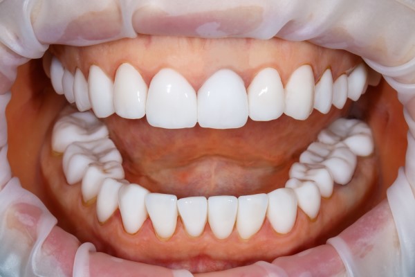 An Estimated Timeline For A Smile Makeover Treatment