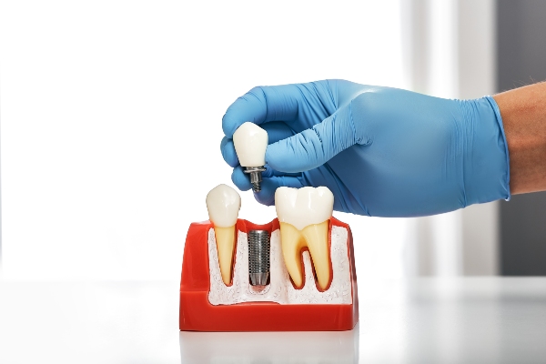 What To Ask An Implant Dentist About Dental Implants